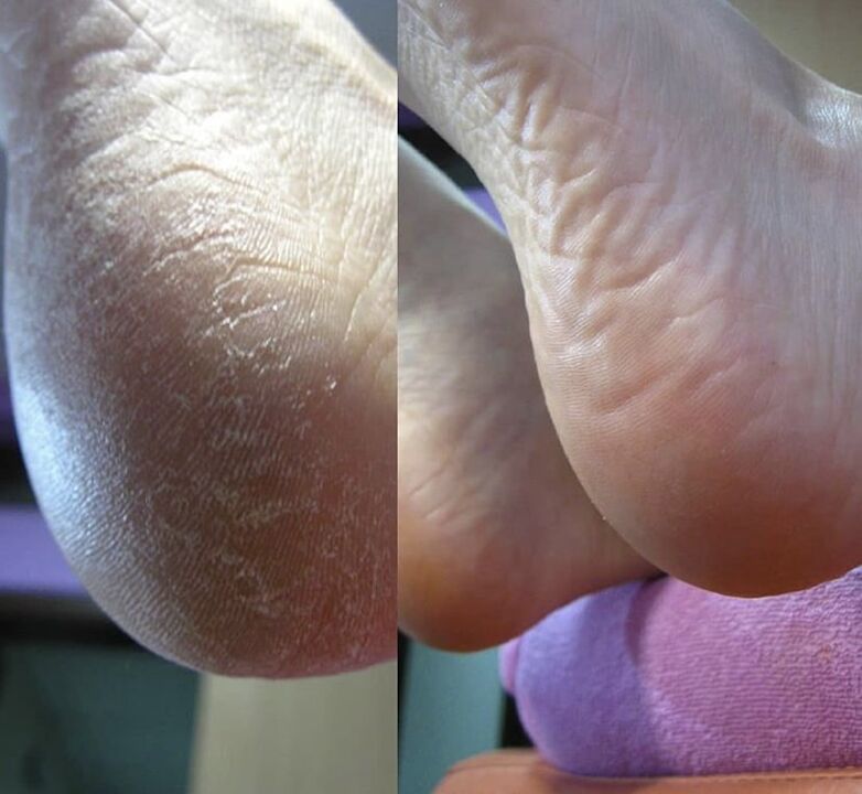 Photo of the heel of the foot before and after using Zenidol