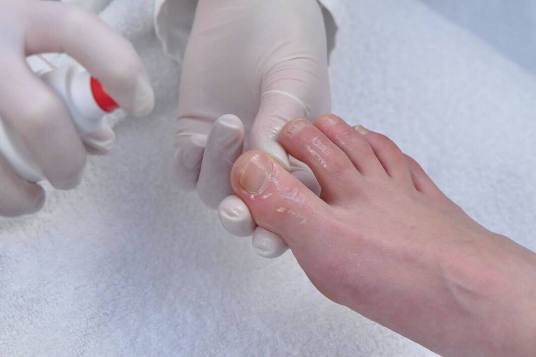 How to cure nail fungus