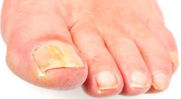 Nail