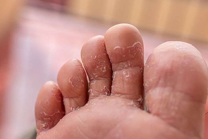 Finger Skin Fungus - Initial Stage