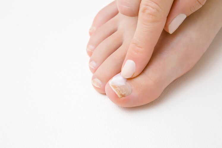 Finger treatment with ointment from the fungus