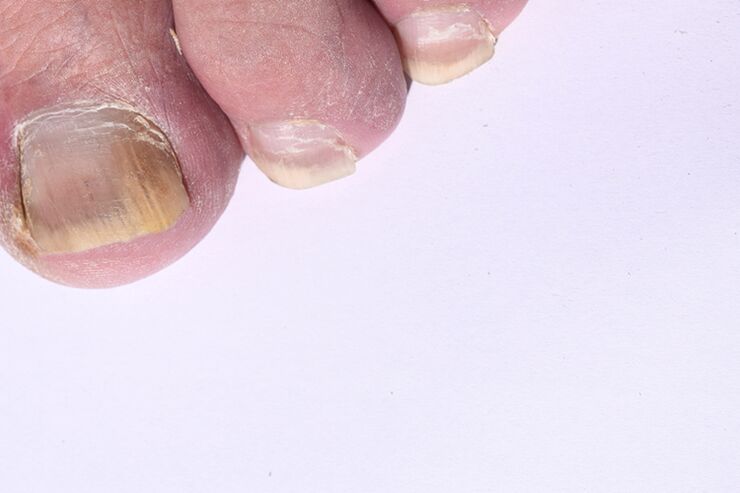The initial stage of nail fungus on the legs