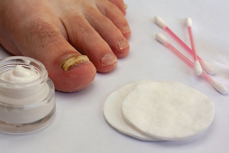Treatment of fungus fungus with cream from the fungus