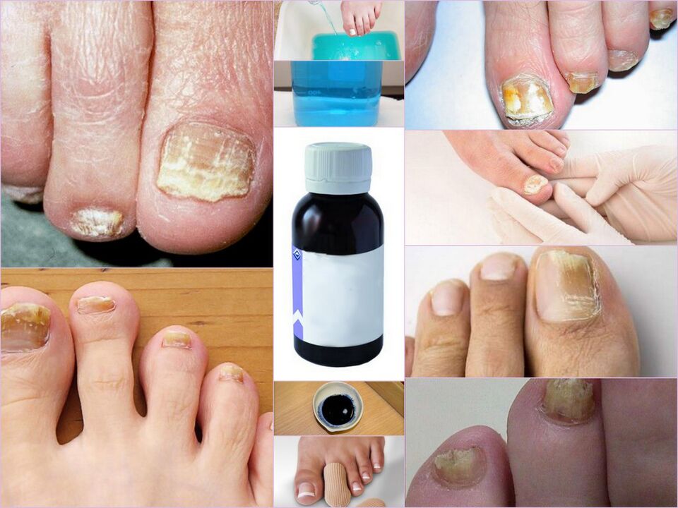 medicines for nail fungus