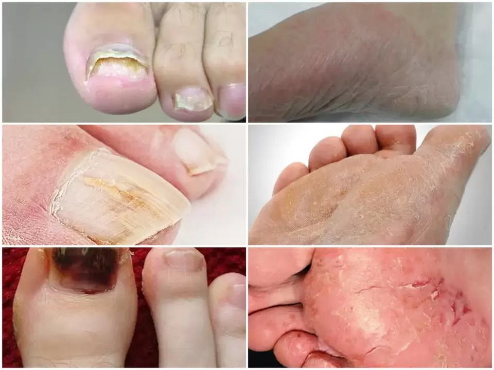 Manifestations of fungi on the legs from various pathogens